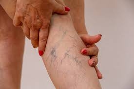 Understanding and Correcting Varicose Veins: A Comprehensive Guide